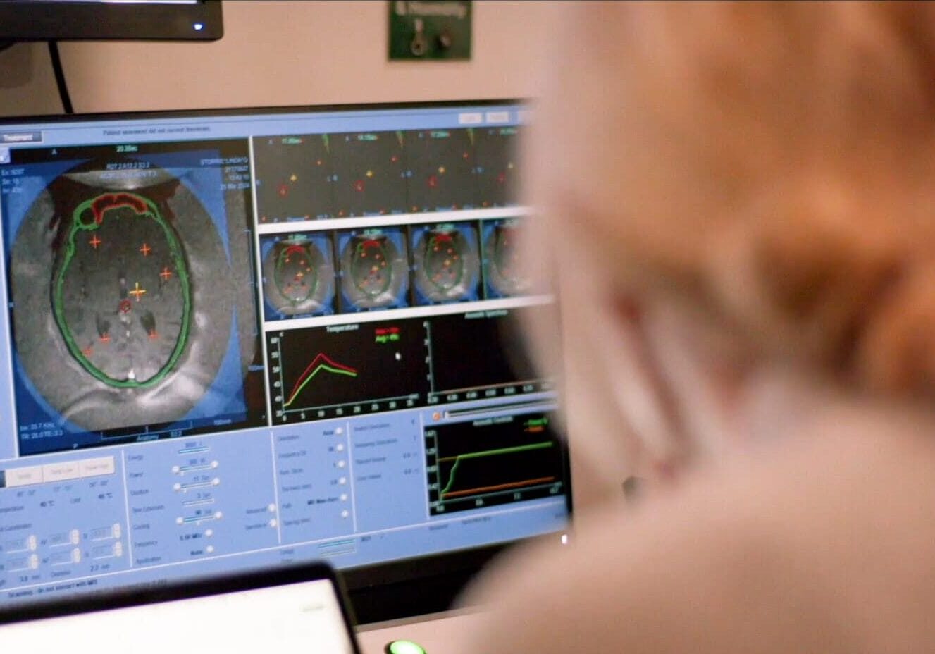 A surgeon undertaking MR guided focused ultrasound procedure for essential tremor.